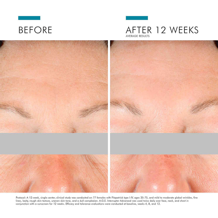 Before and after results of using SkinCeuticals A.G.E. Interrupter Advanced