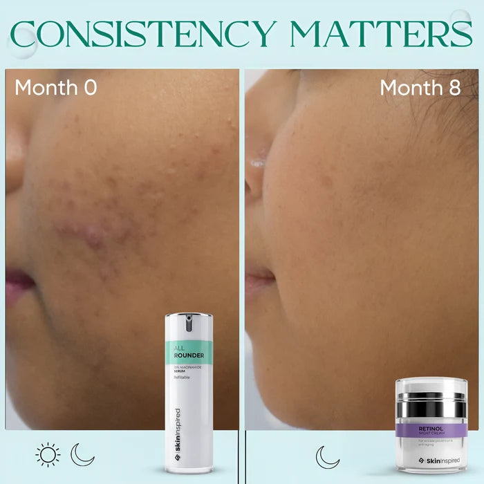All Rounder 10% Niacinamide Face Serum After and Before