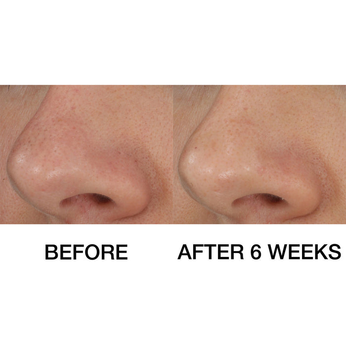 Before and after results of using Clinique Blackhead Solutions Self-Heating Blackhead Extractor
