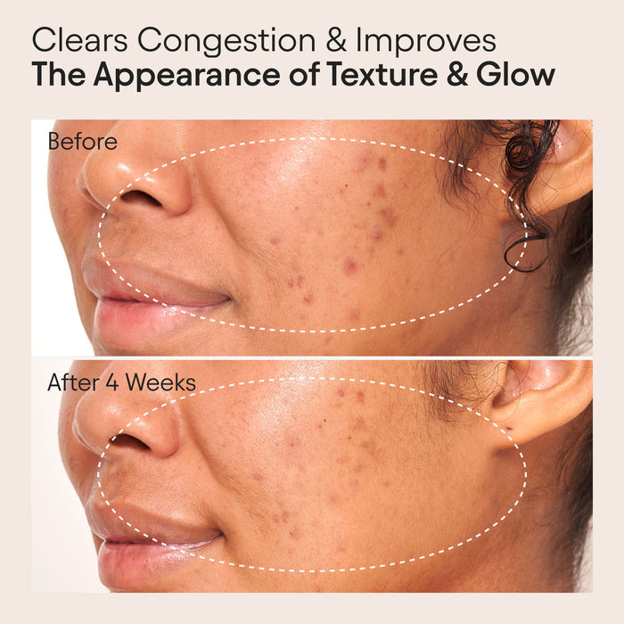 Before and after results of using Alpyn Beauty Clarifying Facial Oil with Retinol and Pink Algae