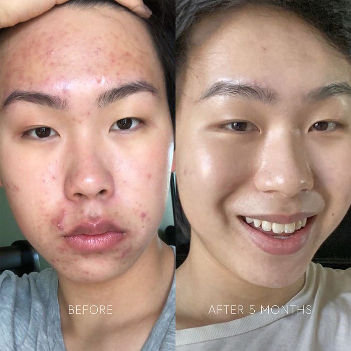 Before and after results of using Dr. Barbara Sturm Clarifying Serum