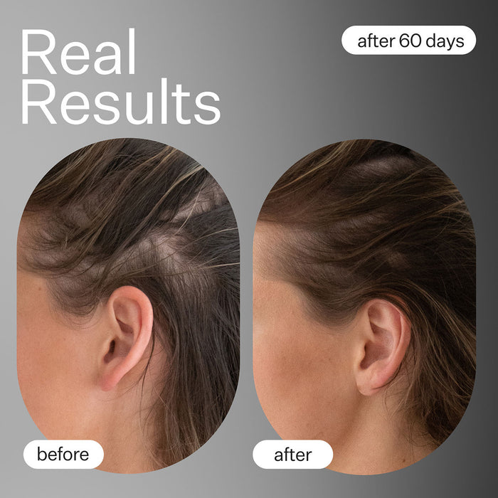 Before and after results of using Act+Acre Dermaroller Hair System