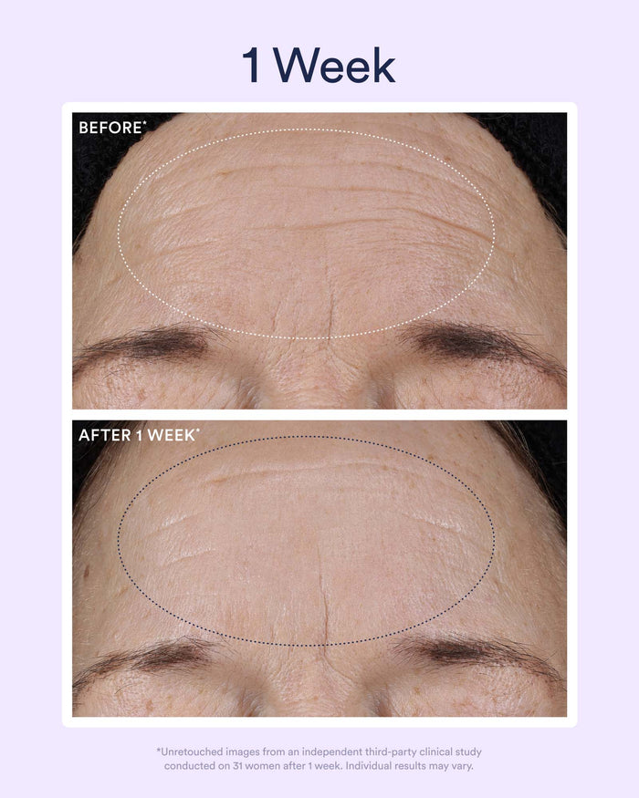 One-week before-and-after images demonstrating visible smoothing of forehead lines