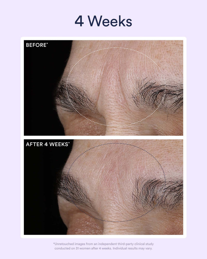 Four-week before-and-after images showing reduction in deep forehead wrinkles