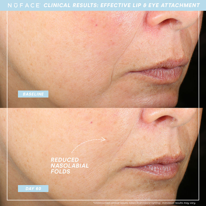 Before and after results of using NuFace Effective Lip and Eye Attachment