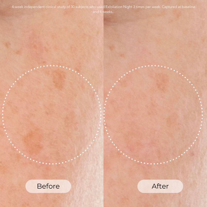 Before and after results of using Dr. Whitney Bowe Beauty Exfoliation Night Resurfacing and Brightening Serum