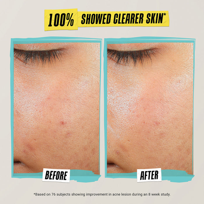 Before and after results of using Kiehl's Since 1851 Expertly Clear Acne-Treating & Preventing Lotion