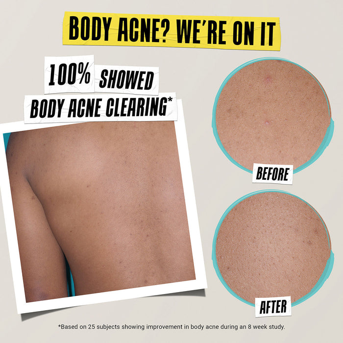 Before and after results of using Kiehl's Since 1851 Expertly Clear Acne-Treating & Preventing Lotion