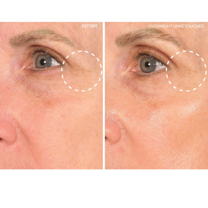 Before and after results of using SIO Eye and Smile Lift variant: 1 Treatment