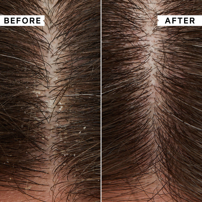 Before and after results of using Philip Kingsley Flaky Scalp Cleansing Shampoo variant: 33.8 fl oz