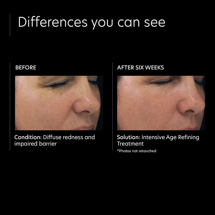 Before and after results of using PCA Skin Intensive Age Refining Treatment