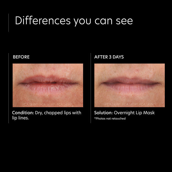 Before and after results of using PCA Skin Overnight Lip Mask