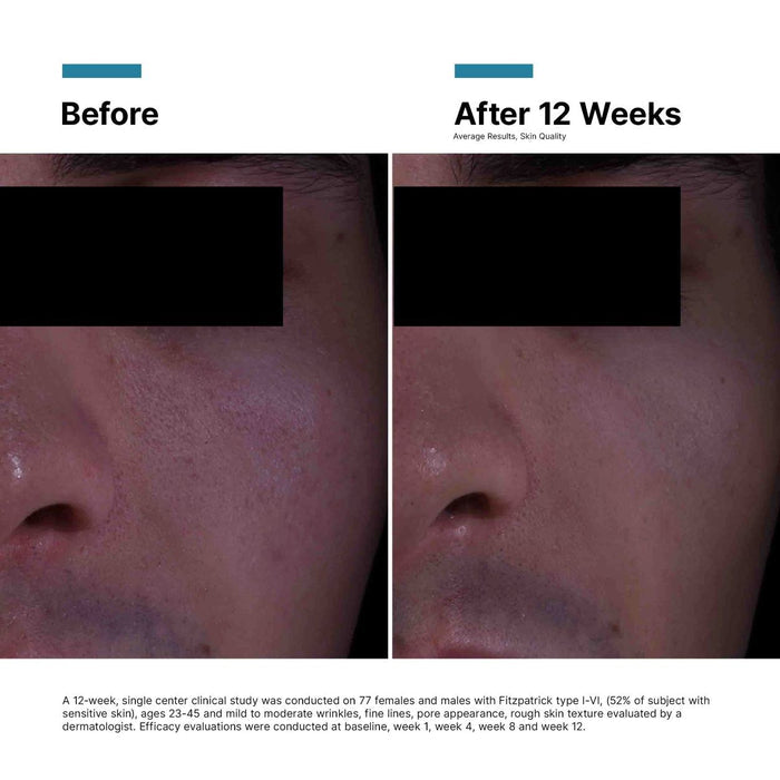 Before and after results of using  P-TIOX Cream variant: Default Title