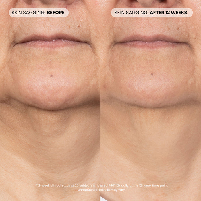 Before and after results of using Dr. Whitney Bowe Beauty P46 Peptide + HA Plumping Serum