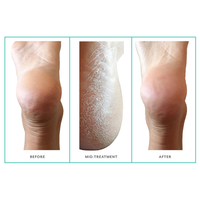 Before and after results of using Patchology PoshPeel Pedi Cure variant: 1 Treatment