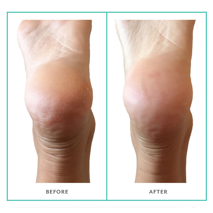 Before and after results of using Patchology PoshPeel Pedi Cure variant: 1 Treatment