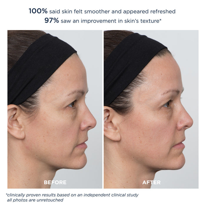 Before and after results of using M-61 PowerGlow Peel Extra Strength 20% variant: 8 Treatments