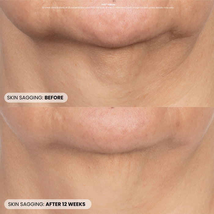 Before and after results of using Dr. Whitney Bowe Beauty Procedure Enhancement Program variant: Default Title