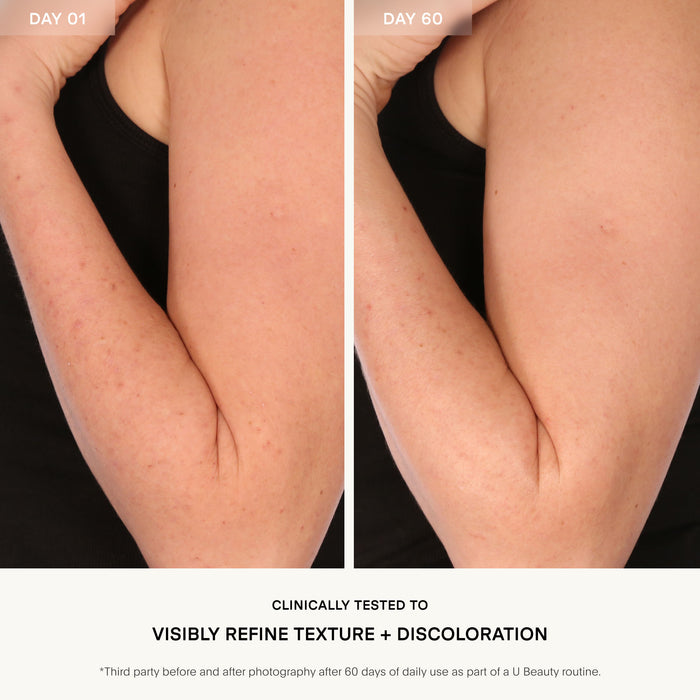 Before and after results of using U Beauty Resurfacing Body Compound