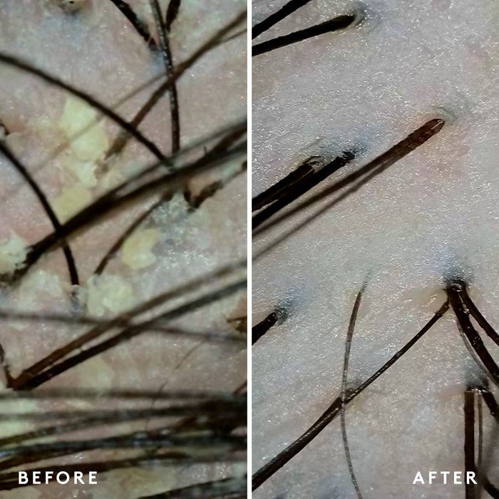 Before and after results of using Virtue Scalp Remedy Conditioner for Scalp and Hair Health