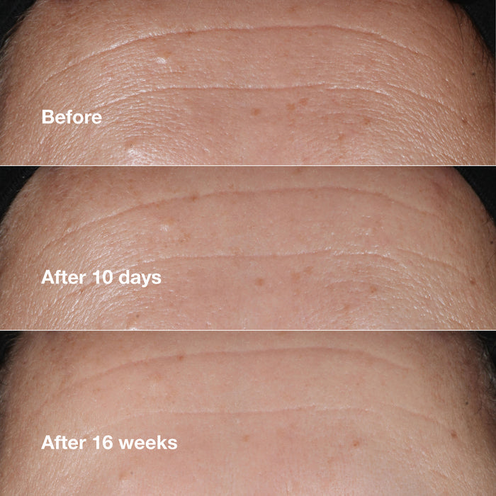 Before and after results of using Clinique Smart Clinical Repair Wrinkle Correcting Serum variant: 1 oz