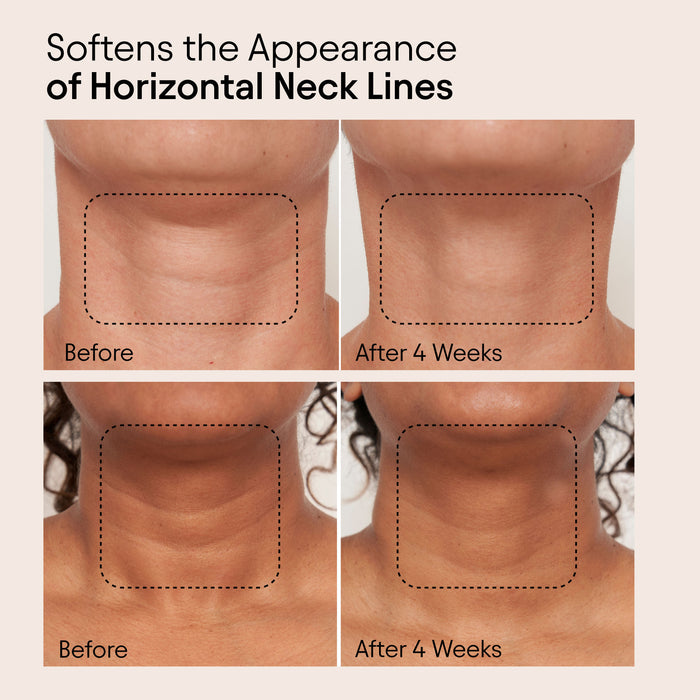 Before and after results of using Alpyn Beauty Super Sculpt Serum For Face and Neck with Tri-Peptide Firming Complex