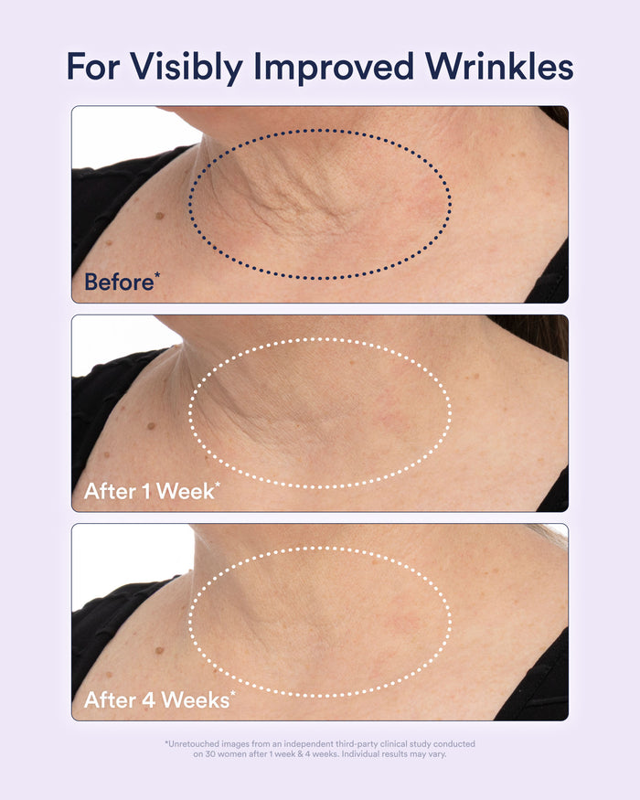 Before-and-after images showing visible improvement in neck wrinkles after one and four weeks