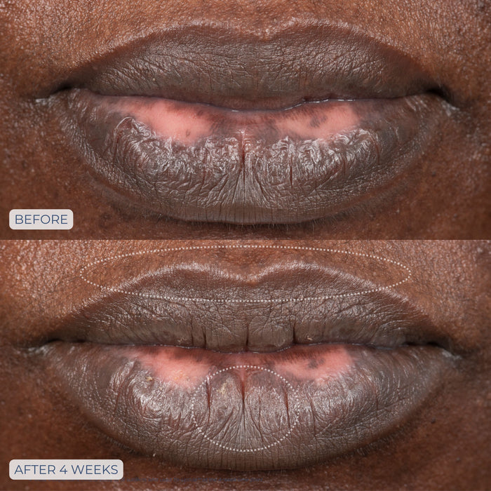 Before and after results of using Dr. Whitney Bowe Beauty Tri-Liptide Peptide Lip Enhancing Treatment
